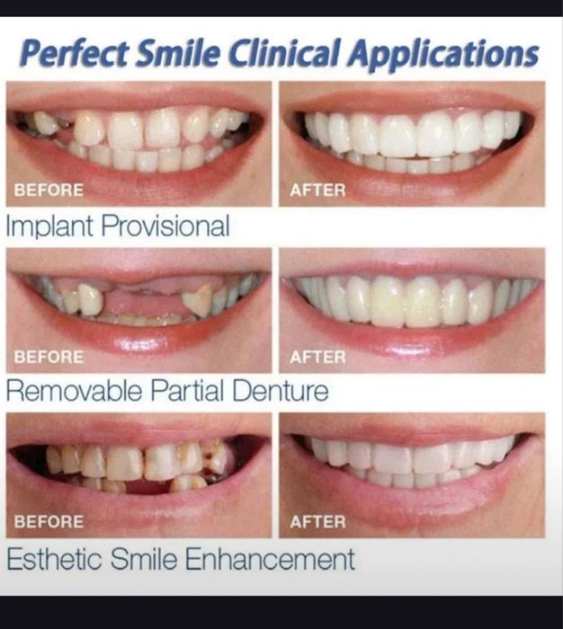 виниры для зубов съмнве