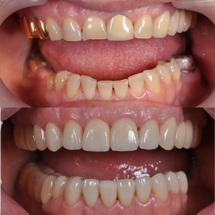 Металлокерамика . Зубные коронки.