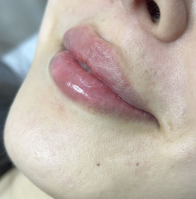 Увеличение губ | Ташкент | Натуральный результат