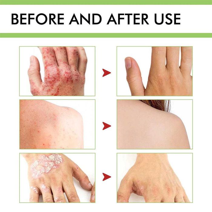 Crema ZB* Psoriazis, dermatita, eczema, prurit, urticarie