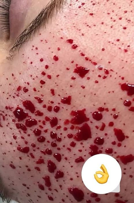 Хиджама профессионально. Банки есть!