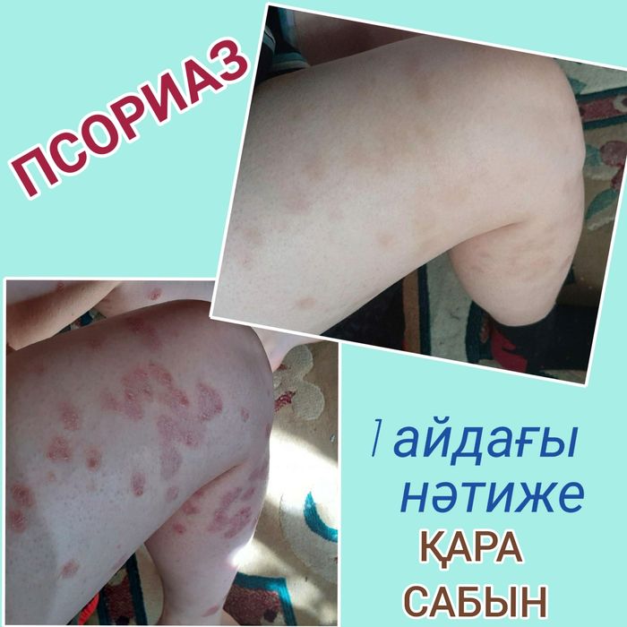 Тері ауруларына қолдан қайнатылған емдік сабын.