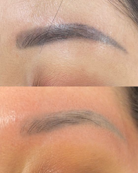 Лазерное удаление татуажа