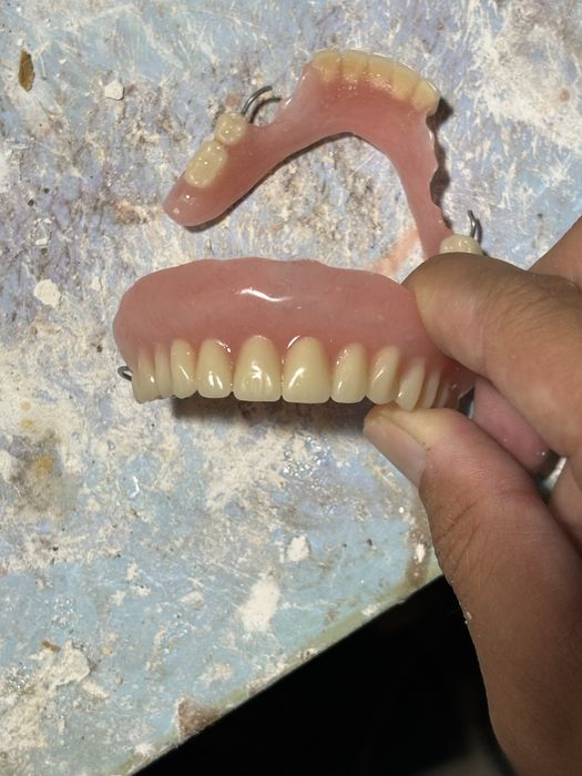 Изготовление сьемных протезов