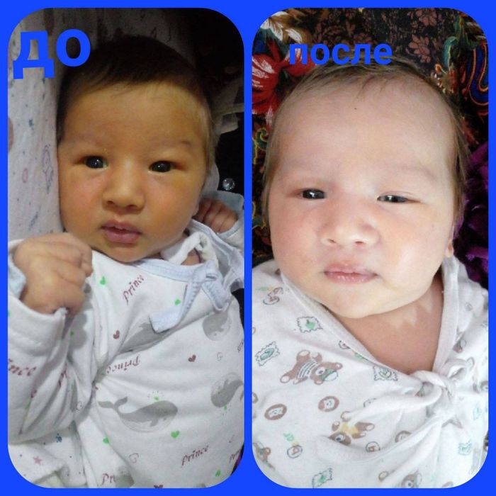 Фотолампа, оғриқсиз ва стресссиз замонавий даволаш усули