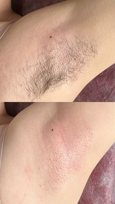 Шугаринг|воск | Депиляция