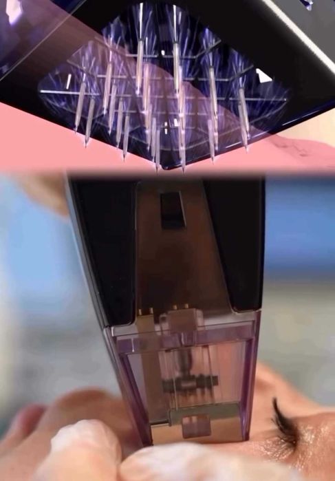 Микроигольчатый RF-лифтинг