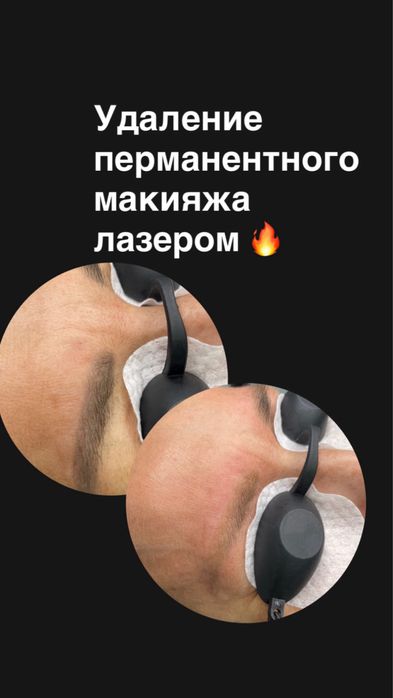 Удаление татуажа