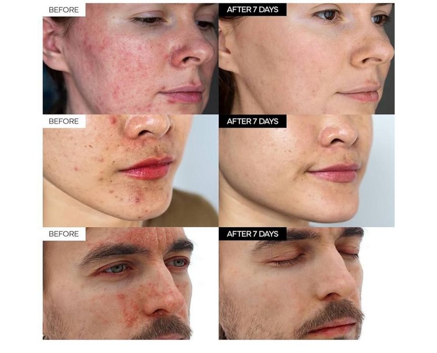 Yuz kremi,akne,toshmalar,doglar,крем,husnbuzar,7 kunda sezirarli natij