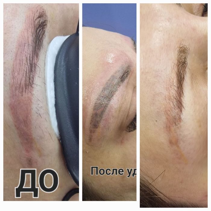 Удаление татуажа брови. 300 тысяч