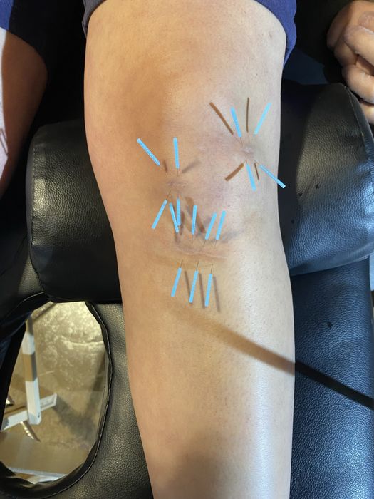 Kinetoterapie, Masaj, Chiropractică și Acupunctură (Dryneedling)