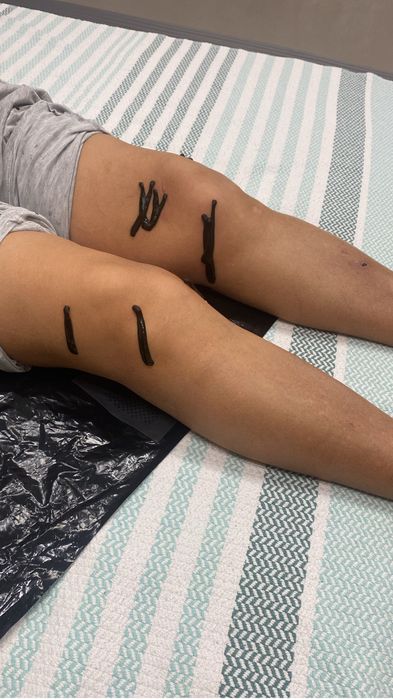 Лечение пиявками Гирудотерапия