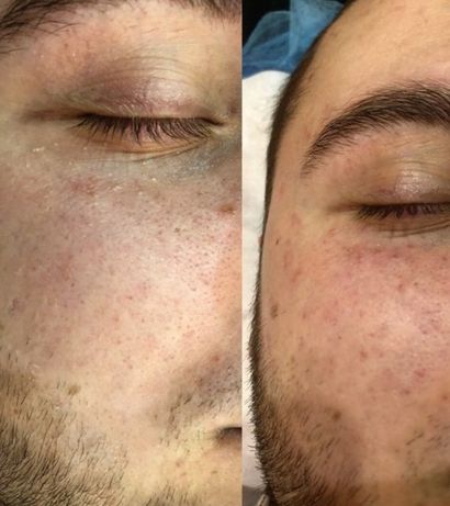 Лазерная чистка лица до и после фото Лазерная чистка лица до и после фото