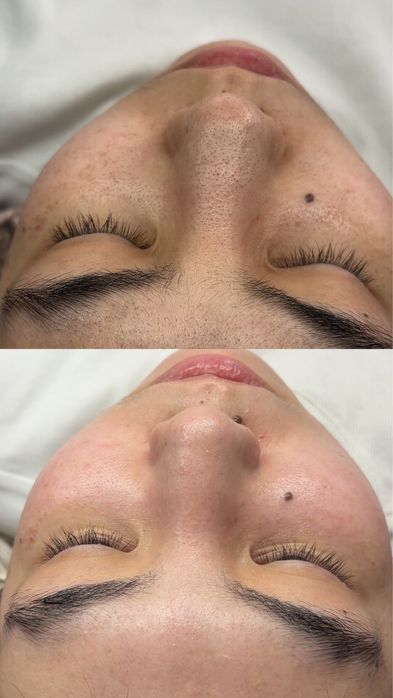 Чистка лица за 5.990