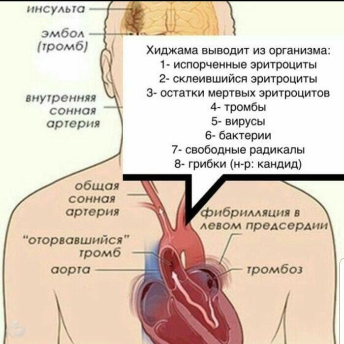 Хиджама от профессионала