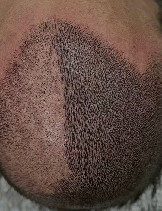 Micropigmentare Scalp și barba Bucuresti SMP chelie implant transplant