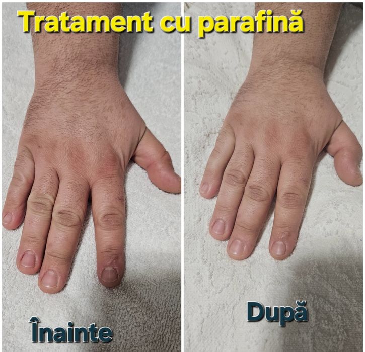 Epilare femei și bărbați, tratament cu parafina mâini și picioare