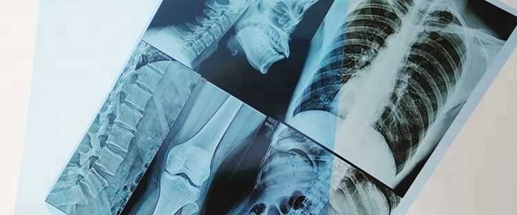 Рентген пленки снимки