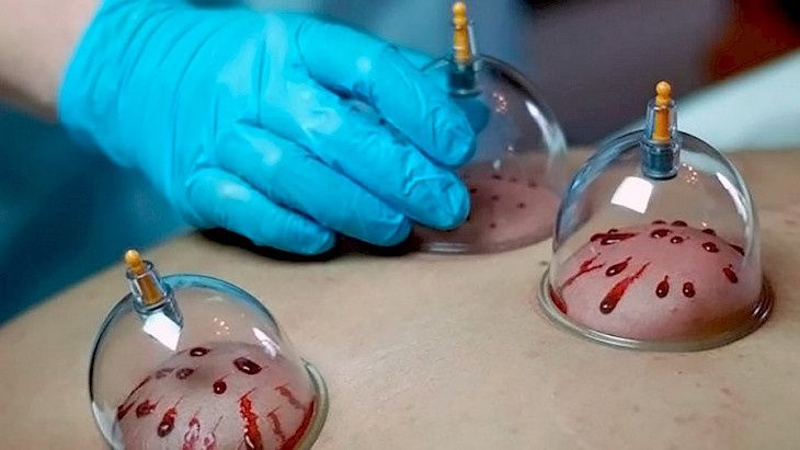 Оздоровительная хиджама.