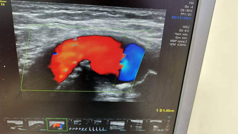 УЗИ (Уздг) сосудов