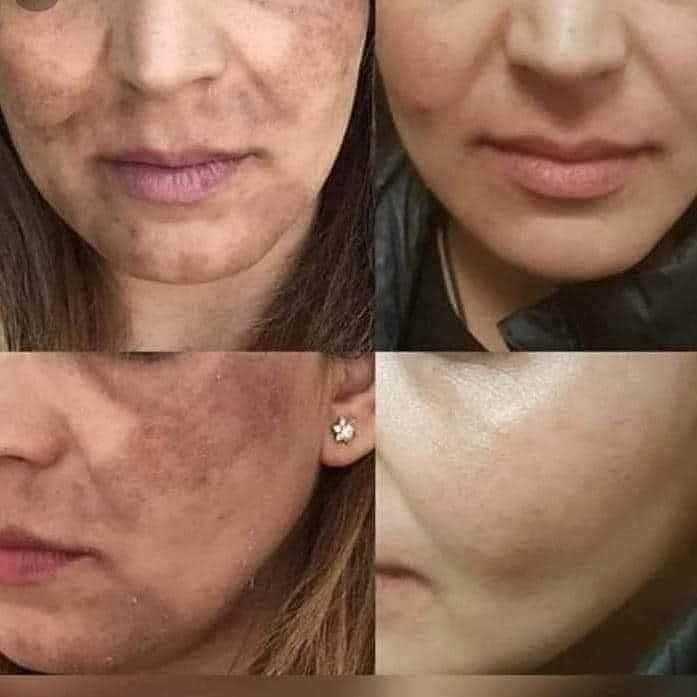 Пилинг лимон - за Вашата чиста кожа месеци наред