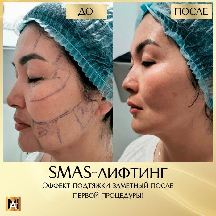 SMAS лифтинг. Безоперационная подтяжка лица. Ультразвуковой лифтинг.