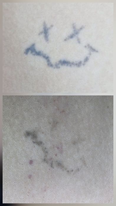 Удаление татуировок любой сложности от 200 тысяч сум