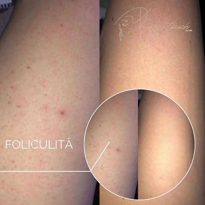 Epilare laser profesional cele mai ieftine servicii din constanta