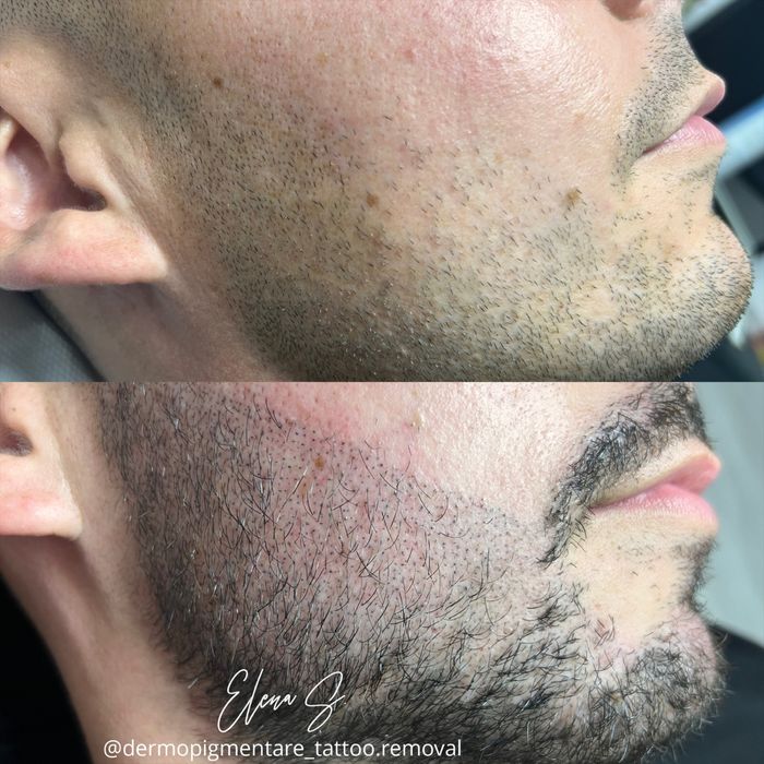 Micropigmentare barba scalp sprancene barbati Bucuresti
