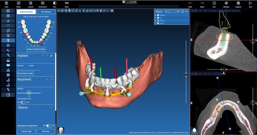 Realguide 5.4.2 + ImplantStation 5.3.2 + BlueSkyPlan + ImplantStudio