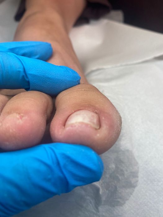 Cabinet pedichiura complexa /onicomicoze /unghii încarnate Alb