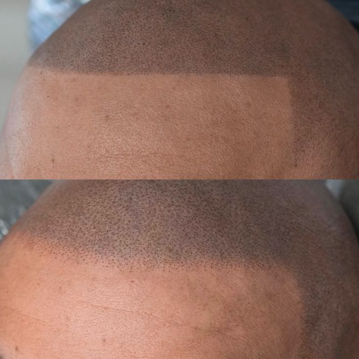 Curs de Micropigmentare Scalp și Barba - Dermopigmentare SMP Academie