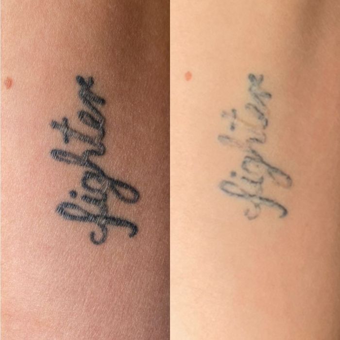 Vand laser indepartat tatuaje 999 e /Inchiriez cu 500 lei/zi