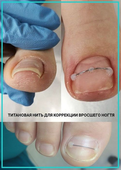 Педикюр титановая нить подолог