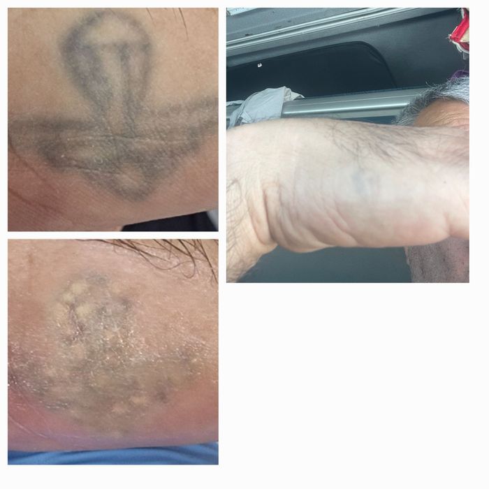 Удаление татуировок любой сложности от 200 тысяч сум