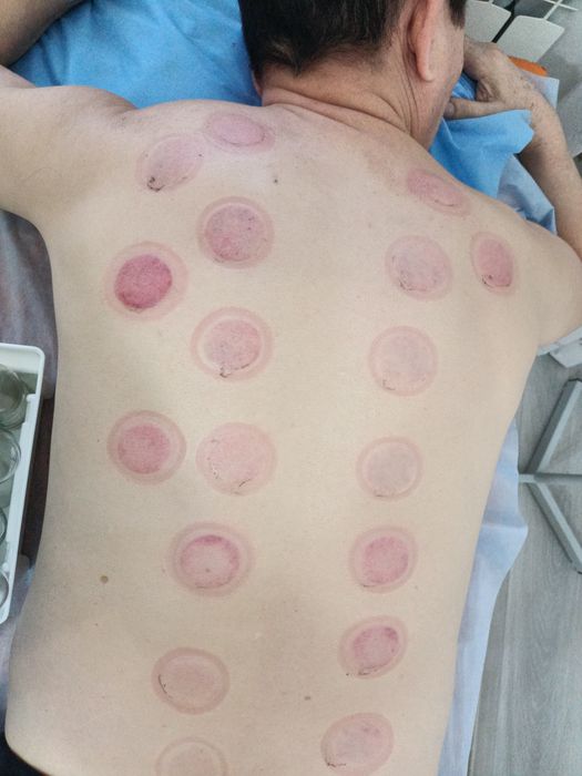 Народный метод лечения.