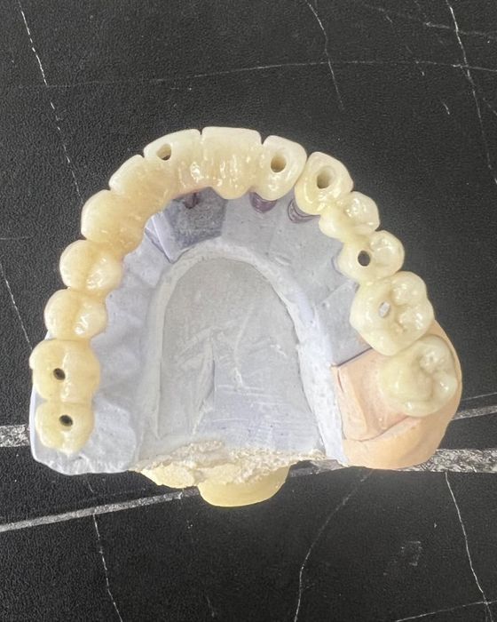 Цирконий / E-max за 2–3 дня | Luminora Dental