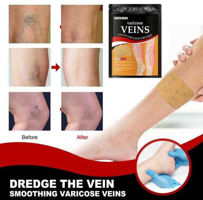 12 Пластири за Разширени Вени Лепенка Лечение Разширени Вени Варикоза