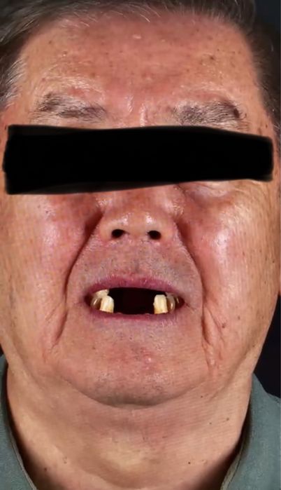 Импланты от 49.999.