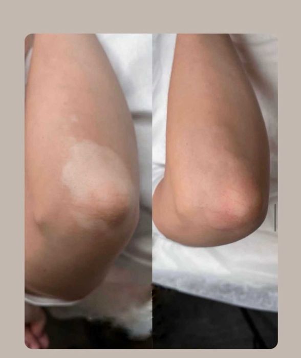 Витилиго камуфляж закраска