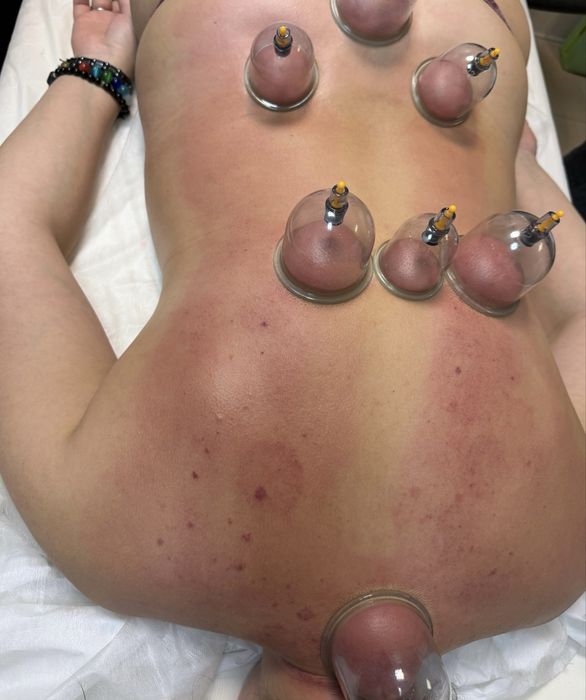 Баночный массаж,хиджама