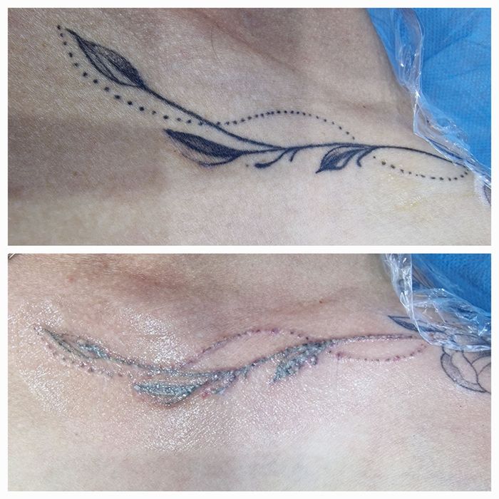 Удаление татуировок  и татуажа