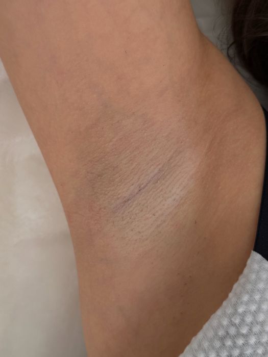 Аппарат лазерной эпиляции mix infinity