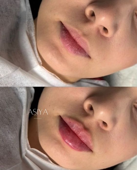 Косметология, увеличение губ, пилинги