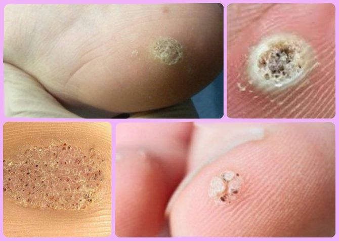 Проблемы с ногами (стопами) и ногтями