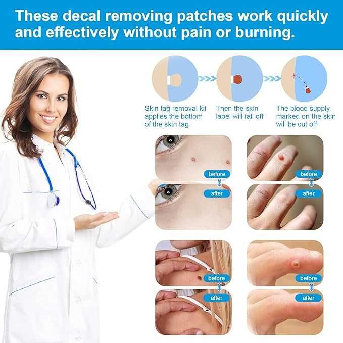 Kioiner Комплект за бързо и безопасно премахване на брадавици