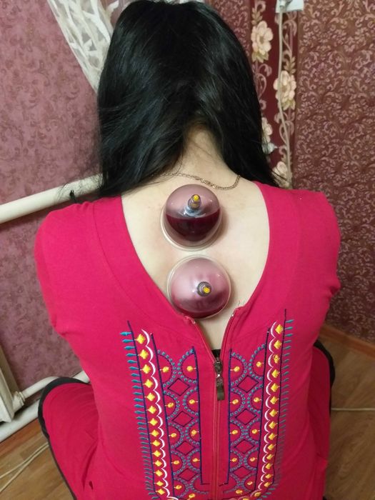 4 микрорайон Салтанат. хиджама копелярное кровапускание