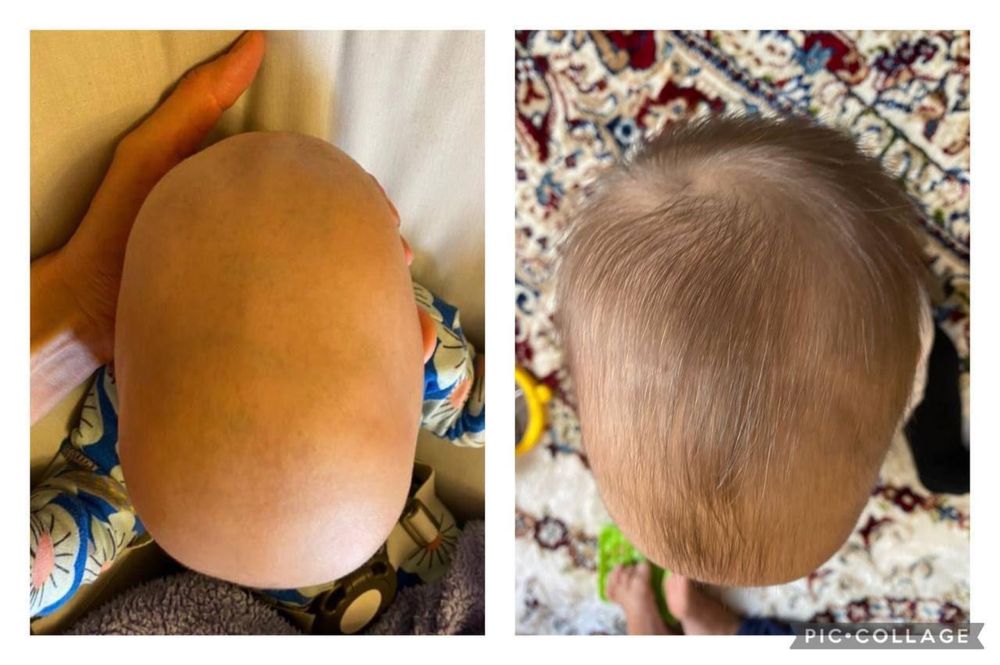 Ортопедический шлем talee