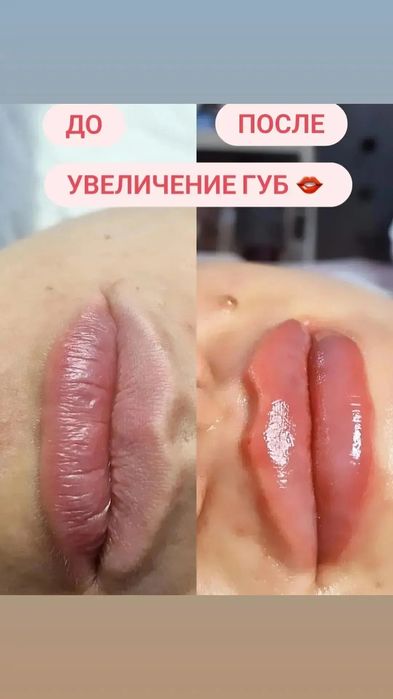 Увеличение губ Косметолог