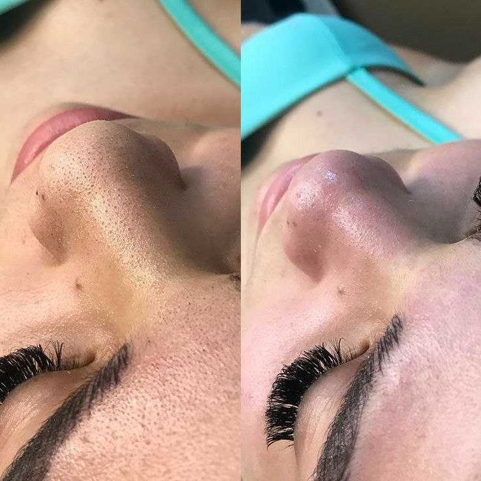 Чистка лица, Yuz tozalash, косметолог.